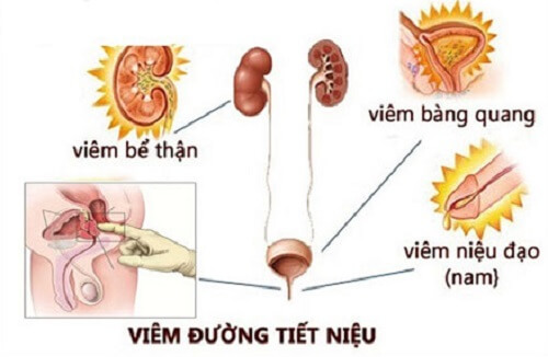 Đái ra tinh trùng- Dấu hiệu bệnh viêm đường tiết niệu 